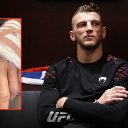 Dan Hooker Shares Gruesome Stitch Removal Video After Hand Surgery